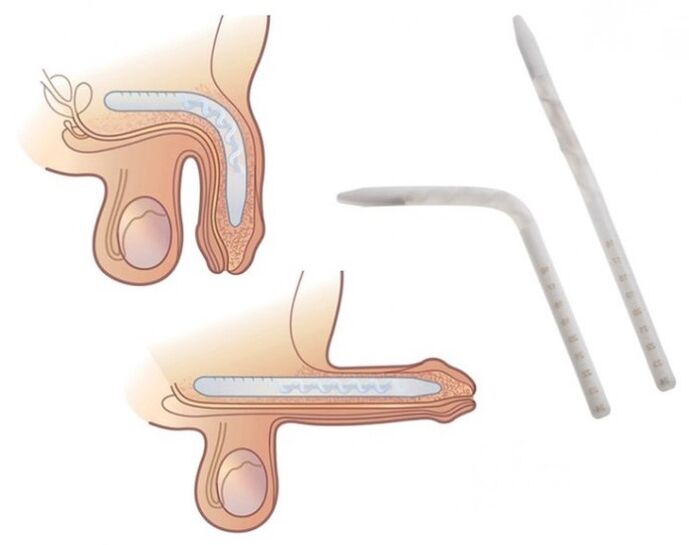 Falloplasty to increase member