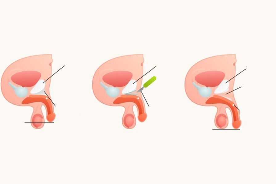Ligamento increase cock