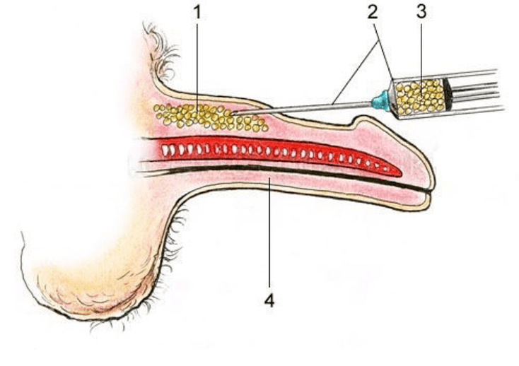 Lipofiling to increase member