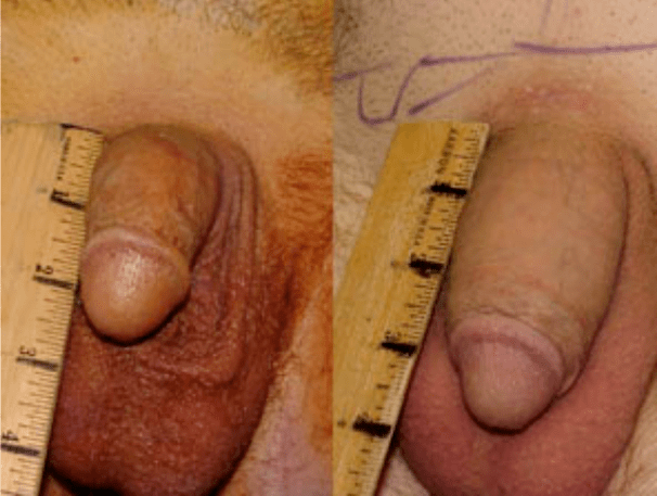 Before and after lipofilling and gel implantation