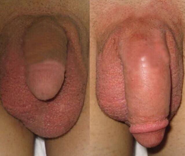 The result of implanting a collagen matrix in the penis