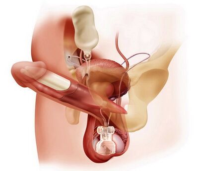 surgical enlargement of the penis