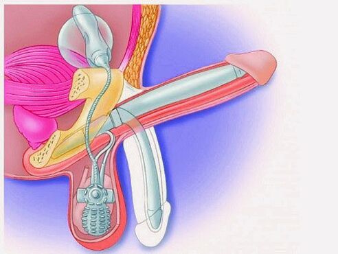 Penis enlargement using a penis prosthesis